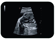 FETAL HEART