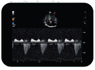 HIGH SENSITIVITY SPECTRAL DOPPLER